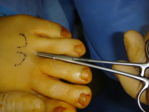 Morton's neuroma: percutaneous release of the nerve
