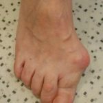 Hallux valgus : big toe deformity, deviated towards the other toes