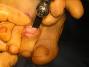 Claw toe: open surgery removal