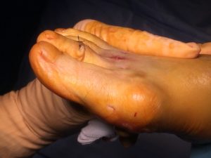 Claw toe: correction of the deformity after surgery