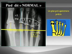 Classical open surgery: Peroperative planning