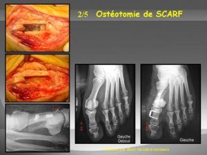 Chirurgie classique : photos opératoires d'une ostéotomie de type Scarf, les coupes osseuses intéressent la tête et la diaphyse du premier métatarsien