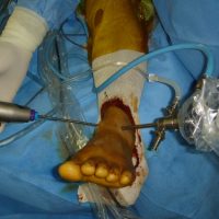 Anterior ankle impingement: arthroscopy is performed through two scars, one for inserting a camera and the other for the instruments