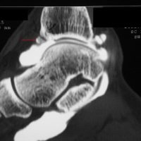 Bony anterior ankle impingement: arthro-CT analyses precisely the cartilage and the osteophytes