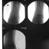 Anterior ankle impingement: a cortisone derivative is injected in contact with the painful tissues under the control of an X-ray