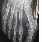 Percutaneous surgery for hallux valgus: exostosectomy burring