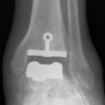 Totale ankle replacement: postoperative X-ray of a total ankle prosthesis