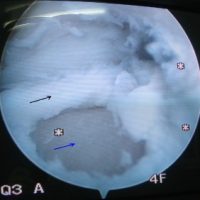 TDL: The arthroscopic exploration visualises the cartilage lesion (black arrow) and the subchondral bone (blue arrow).