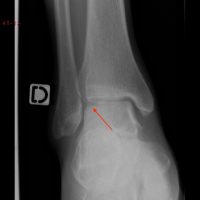 Lateral subchondral bone TDL laying on the lateral edge of the talus and visible on regular X rays. It necessarily traduces a cartilage lesion.