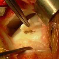 TDL – Mosaicplasty : removal of the TDL before drilling.