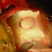 TDL – Mosaicplasty: the bone and cartilage graft is implanted in the talus, in the location of the TDL.