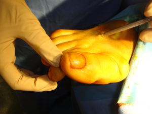 Claw toes: percutaneous tenotomy of the extensor digitorum longus tendon