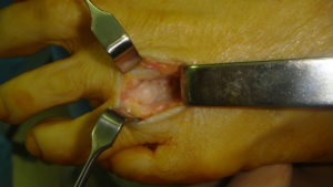 Morton's neuroma: surgical view of the white oval tumefaction corresponding to the neuroma