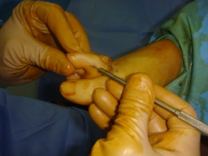 Claw toes: percutaneous tenotomy of the flexor brevis tendon