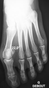Hallux valgus : preop X-ray