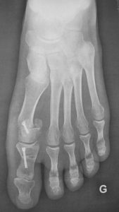 Hallux valgus: correction with minimally invasive chevron and percutaneous P1 osteotomy