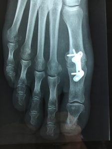 Hallux rigidus: major joint wear leaves no other option than fusion, called arthrodesis.