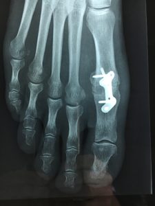 Hallux rigidus : l’usure articulaire majeure impose le blocage (ou fusion), appelée arthrodèse