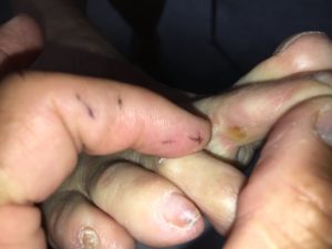 Conflict between toes: interdigital corn