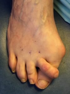 Conflict between toes: 2nd toe supradductus