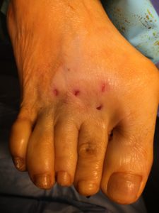 Conflict between toes: postoperative correction