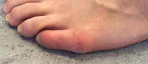 Taylor bunion: bursitis resulting from the conflit with footwear