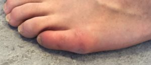 Oignon de Taylor: bursite due à un conflit avec les chaussures
