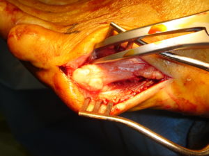 Taylor bunion: open surgery approach of the 5th metetarsal