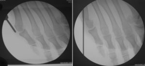 Taylor bunion : 5th metatarsal's head percutaneous burring and osteotomy