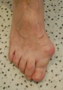 Hallux valgus: great toe deformity deviated towards the other toes