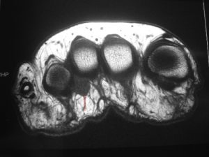 Morton's neuroma: on the MRI, the 3rd space is filled by a black mass in a pear shape (red arrow)