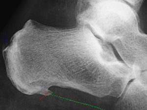 Plantar fascia : the classical image of calcaneal spur has nothing to do with the pathology