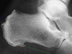 L'image classique de l'épine calcanéenne n'a rien à voir avec la pathologie de l'aponévrose plantaire