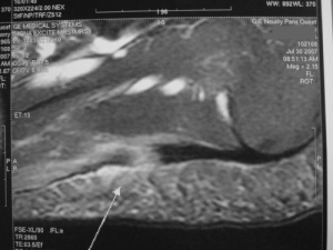 Plantar fascia : in case of doubt, a rupture is confirmed by the MRI