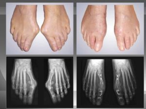 Avant et après une chirurgie classique à ciel ouvert de l'Hallux valgus