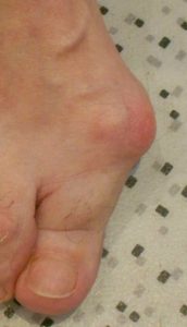 Hallux valgus: bursitis developed where the deformity is maximal