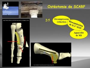ostéotomie de type Scarf, les coupes osseuses intéressent la tête et la diaphyse du premier métatarsien