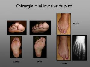 Mini-invasive surgery – Clinical case 1 : open surgery on the 1st ray and percutaneous surgery on the lateral rays