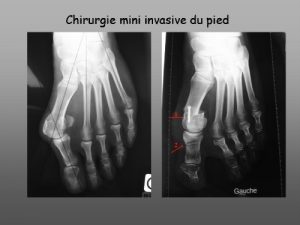 Chirurgie mini invasive sur le 1er rayon (chevron) et chirurgie percutanée sur les rayons latéraux