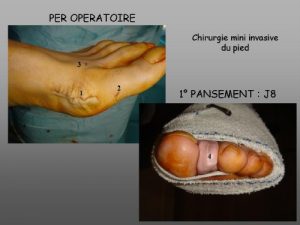 Minimally invasive surgery – clinical case 2 : minimally invasive surgery, postoperative aspect