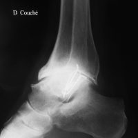 Conflit antérieur osseux : radiographie de profil révélant les volumineux ostéophytes en avant du tibia et au col du talus