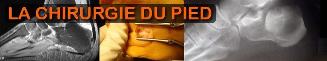 Chirurgie du Pied