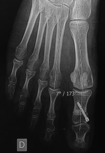 Hallux valgus interphalangeus: posteoperative X-ray where the base and the head of the first phalanx are now parallel