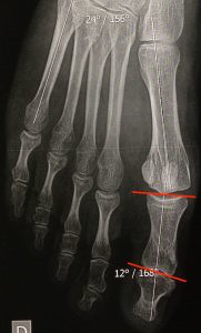 Hallux valgus interphalangeus: proeperatove X-ray with base and head of P1 not parallels