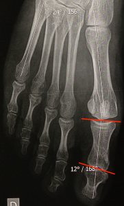 Crosse latérale : sur la radiographie préopératoire, la base et la tête de P1 ne sont pas parallèles