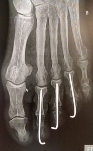 Claw toes: PIP arthrodesis fixed with removable K-wires