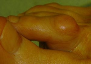 Orteil en griffe : griffe proximale avec cor dorsal en regard de l'articulation IPP
