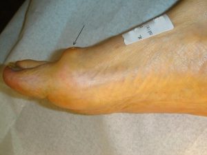 Hallux rigidus: bone production at the dorsal aspect of the joint, visible under the skin, in conflict with the shoe