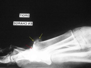 Hallux rigidus : la production d'os au dos de l'articulation est visible sur la radiographie de profil. Elle porte le nom d'ostéophytes