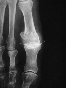 Hallux rigidus: narrowing of the joint space on the X ray
